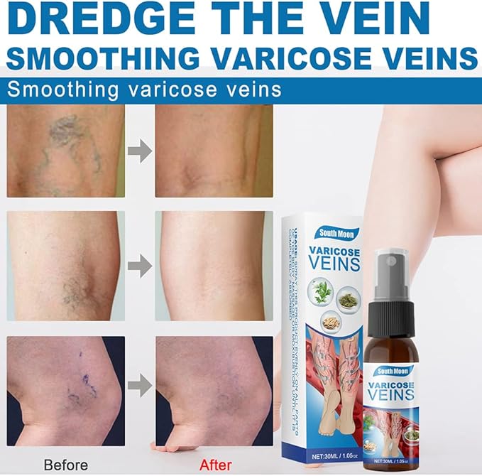 South Moon - Varicose Veins (Original)