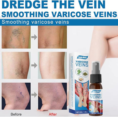 South Moon - Varicose Veins (Original)